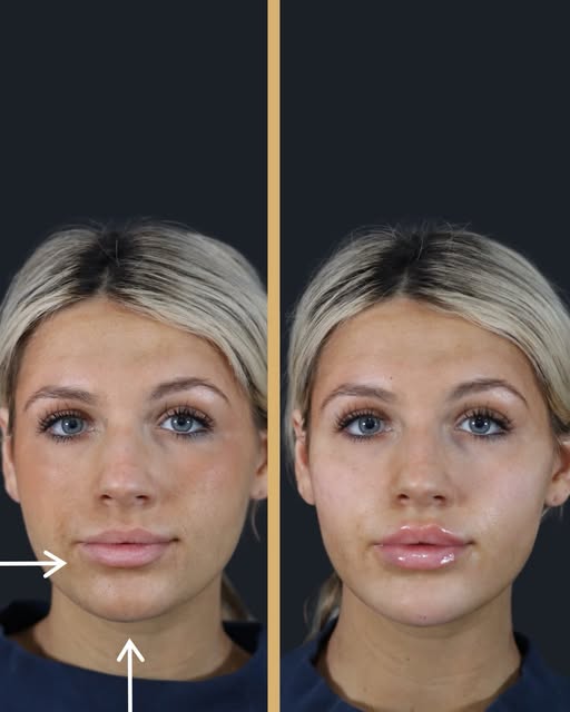 Immediately after treatment-  Cheek + chin + lip filler 😍