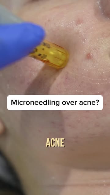Have you heard of Microneedling over active acne? 🤔💉

Historically it has been thought that perfor