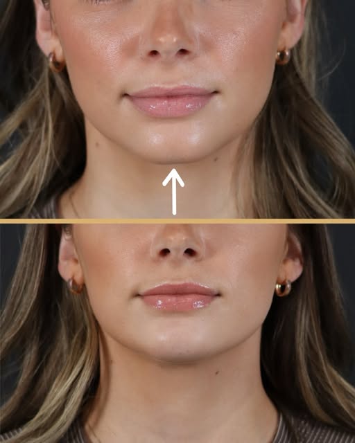 A little chin filler & Botox 🫶