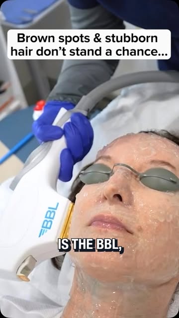 BroadBand Light (BBL) can target more than one skin concern, which is why it’s such a versatile trea