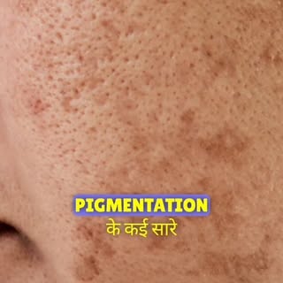 Pigmentation Removal In Just One Session?
Pigmentation Needs These Three Care
1. Regular Skin Care
2