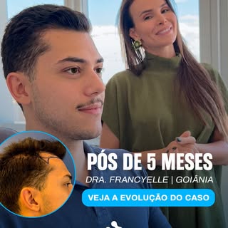 Em menos de 5 meses, o Breno já apresenta uma evolução muito positiva no transplante capilar.

Neste
