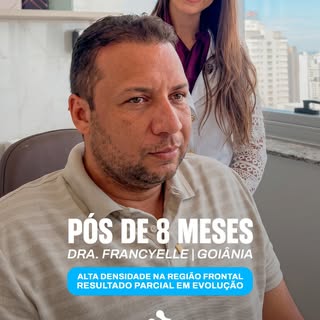 Pós de 8 meses. Neste caso, o paciente já apresentava um grau de calvície mais avançado, e o direcio