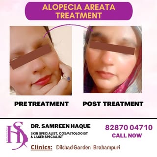 Before and after Alopecia Areata Treatment at Skin n Vision Centre. #bestdermatologist #skindoctor #