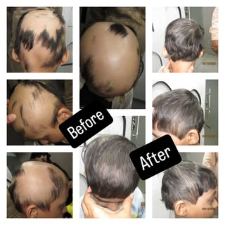 Alopecia totalis