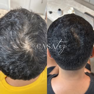 “Dr, até o pessoal da barbearia notou meu cabelo mais cheio.”

Coroa completamente restaurada em alg