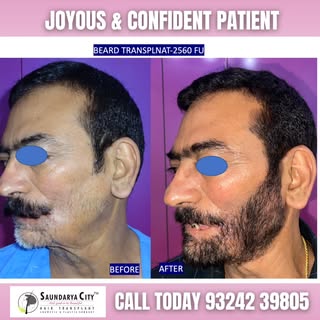 From patchy to perfect — here’s a real transformation that defines precision and confidence. 💪
At S