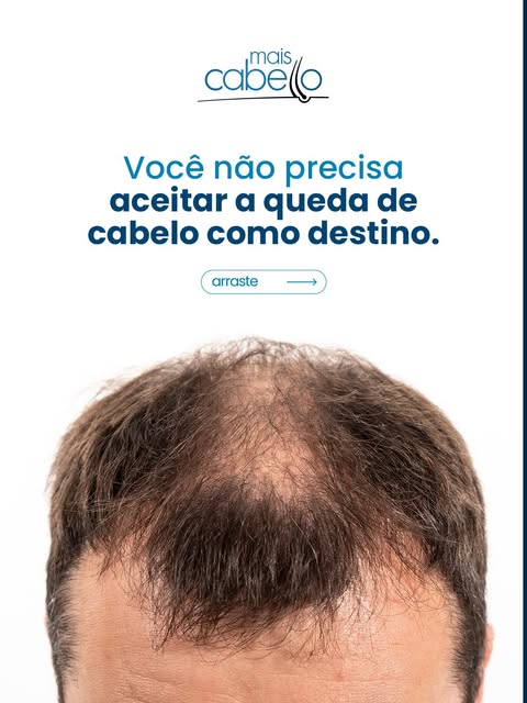 Você muda o ângulo das suas fotos só pra esconder a entrada do cabelo? 🤔

A calvície não é sobre va