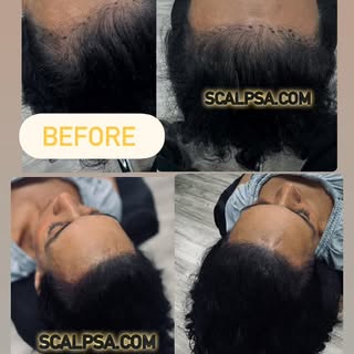 ✨ Scalp Micropigmentation for Women at ScalpSA ✨Restore the look of fuller, denser hair with the mos