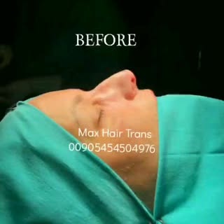 BEST RESULTS🤗😎✔️ MAX HAIR TRANS 📢#rinoplasti #womenhairtransplant #sapphire #hairtransplant #free