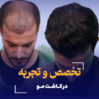 ✨ “بازیابی اعتماد به نفس و زیبایی با کاشت مو در کلینیک ایران نوین! در کلینیک ما، از تجهیزات پیشرفته 