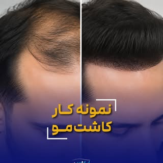 وقتی دوباره موها شروع به رشد می‌کنن، اعتمادبه‌نفس هم برمی‌گرده ✨

این قبل و بعد تنها چند ماه فاصله د
