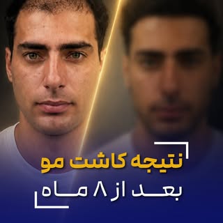 ⁨	۸ ماه فاصله بین این عکس و فیلم… اما چیزی که می‌بینید فقط «مو» نیست؛ تغییر چهره و اعتمادبه‌نفسه. 🔥