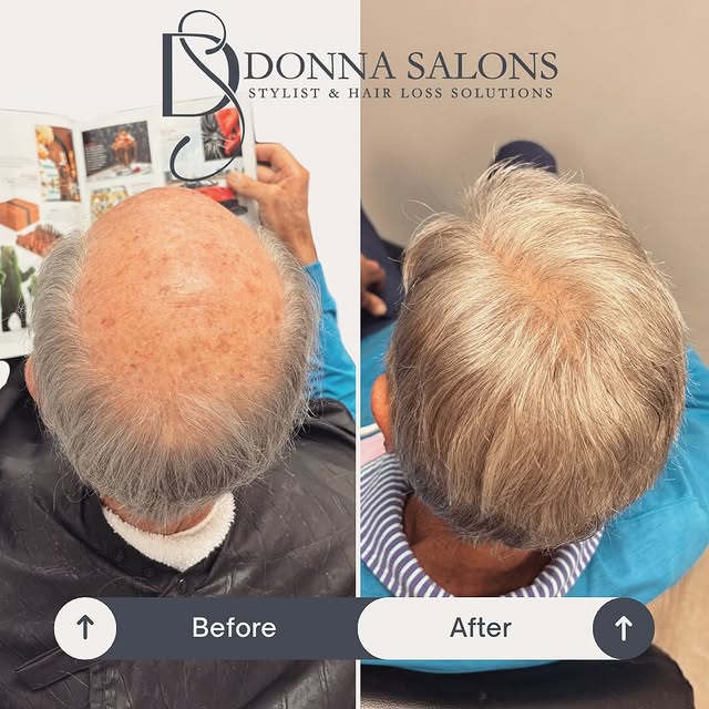 🌟✨ Say goodbye to hair insecurities and hello to the mane of your dreams! 🙌 Our nonsurgical hair r