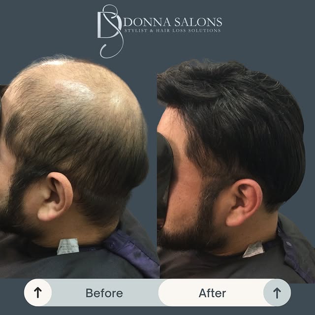 ✨ Confidence Restored. Life Renewed. ✨

Hair loss can affect more than just your appearance; it can 