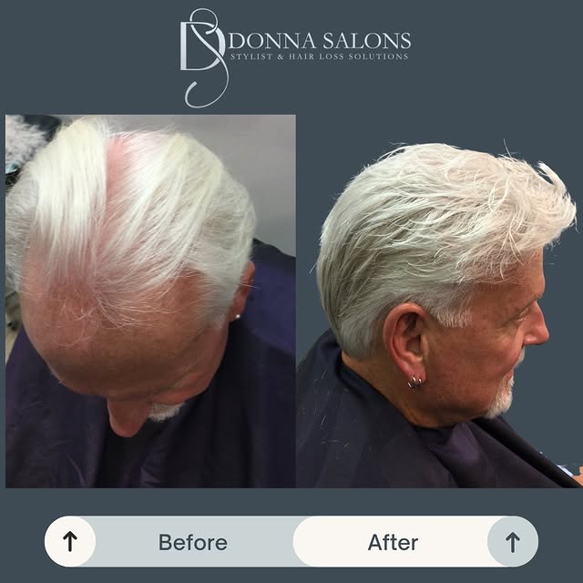 ✨ Confidence restored. No surgery. No compromise. ✨

This before & after says it all.
Our client wal