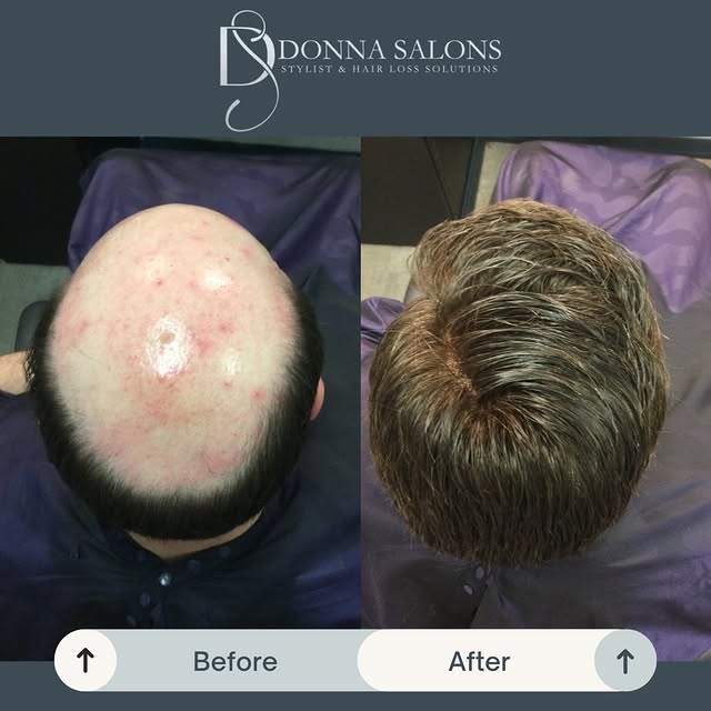 From balding to a full, natural-looking transformation ✨
This men’s bonded hair replacement before &