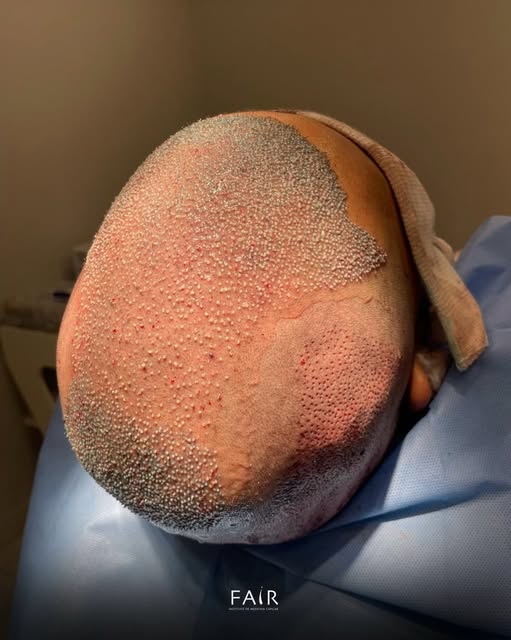 Menos um careca no mundo! 👨‍🦲

Paciente de 30 anos procurou o Instituto Fair com queixa de entrada