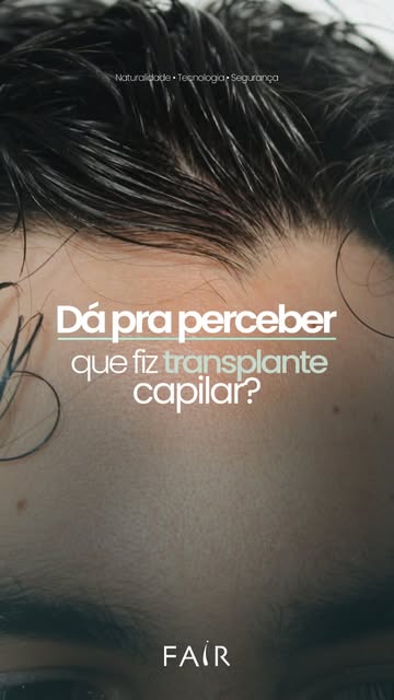 Dá para perceber que fez transplante? Quando o resultado é denso e natural, a resposta é: não.

No I
