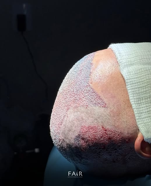 Menos um careca no mundo! 👨‍🦲

Paciente de 47 anos, gaúcho e residente em Divinópolis, procurou o 
