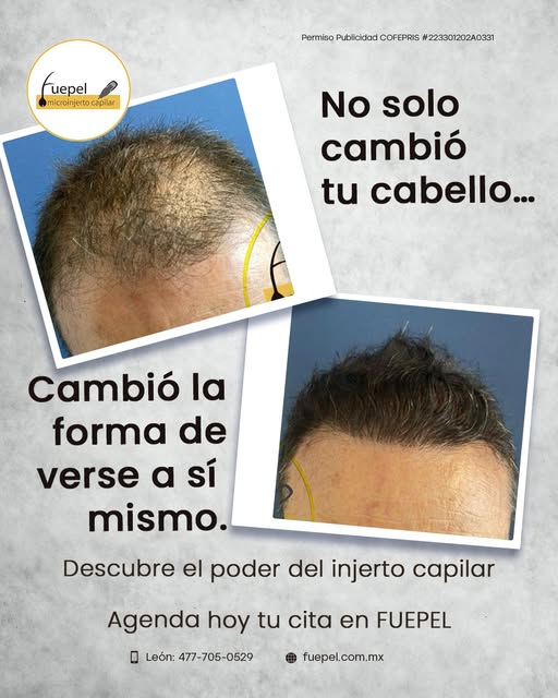 🌿✨Cada injerto capilar se personaliza para lograr un resultado natural y acorde con cada paciente. 