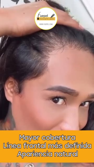 24/7, todos los ángulos y millones de miradas. 👀🏠

Hoy, la evolución del injerto capilar de Karina