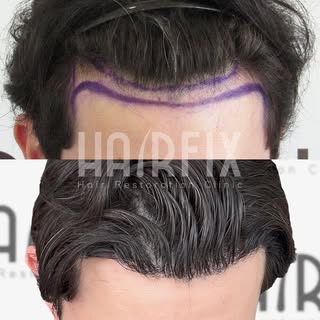 A natural-looking hairline can make a remarkable difference. This transformation shows how a persona
