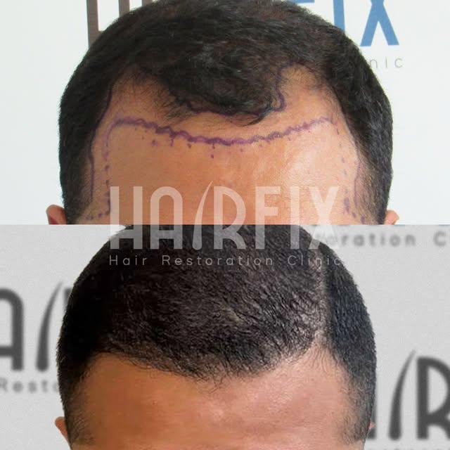 From a receding hairline to a fuller, more defined look! 😎 This before & after highlights the impac