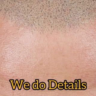 DETAILS not DOTS. When OCD meets SMP - you get the best Scalp Micropigmentation on earth 🤠

I treat