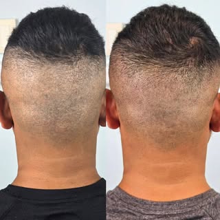 FUE Hair Transplant Scar Coverage in Houston, TX.  2 sessions later. I think we will need one more s