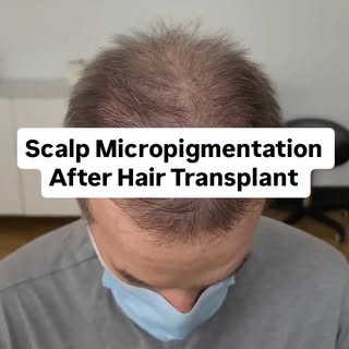My 76 Year-Old client from San Antonio - he had both an FUT and FUE hair transplant to make thicker.