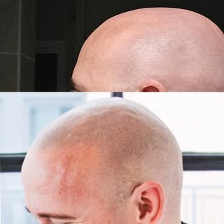 Selfie time! Justin could have gone anywhere for his Scalp Micropigmentation and after alot of resea