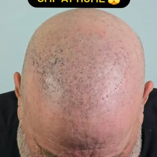 Doing your own Scalp Micropigmentation? Larry gave Scalp Micropigmentation a go, but thankfully he s