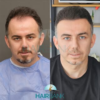 From struggle to confidence! 🌟
Witness the incredible transformation of our patient after their hai