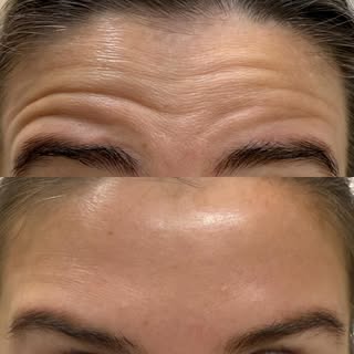 Results from Dysport- neurotoxin- treatments may vary from person to person. Full results typically 