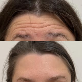 ❤️The beauty of Botox is subtle confidence—smoother lines, refreshed features, and results that stil