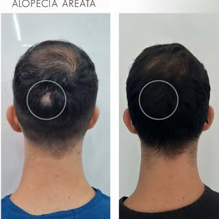 La Alopecia Areata es una enfermedad multifactorial en la que participan factores genéticos, factore