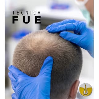 En el centro Golden Hair de implante capilar utilizamos la técnica FUE - que consiste en extraer ind