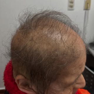 En esta semana nos visitó nuestra paciente con liquen plano pilar, un tipo de alopecia cicatrizal qu