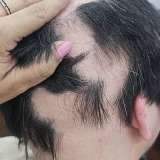 Con autorización previa les presento el caso de un paciente joven que nos consultó por una alopecia 