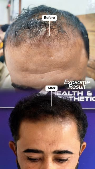 Unlock the future of hair & skin regeneration! ✨ Introducing Exosomes Treatment – the cutting-edge s