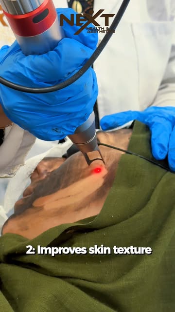 Say goodbye to stubborn pigmentation and hello to a brighter, more even complexion with Pico Laser T