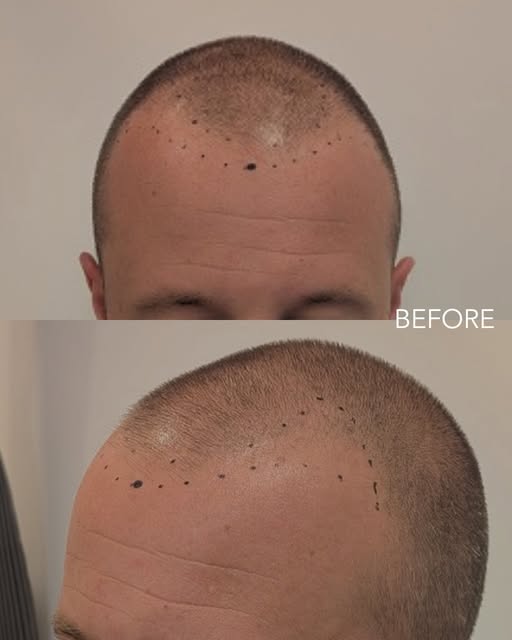 A 4000 graft procedure, photographed two weeks on.

A case of this size is planned in detail well be