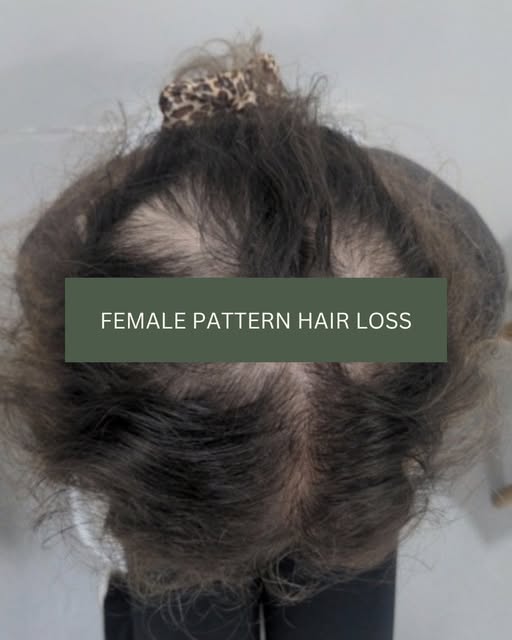 Hair loss in women often presents differently to the pattern most people picture.

Diffuse thinning,