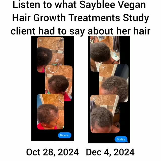 #SaybleeSays, everyone with hair loss have real and deep emotional concerns. Especially postpartum h
