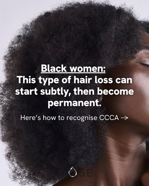 CCCA is one of the most important causes of scarring hair loss to recognise early in Black women.⁠
⁠