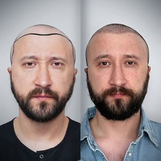+5.650 Graft
The operation was performed on 16.03.2024 The shared result image belongs to the patien