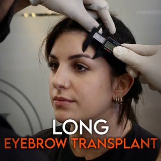 Long Eyebrow Transplantation

Long Eyebrow Transplantation is one of the techniques used to address 