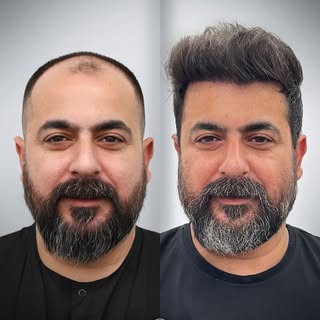Grafts: 5,600

The operation was performed on 21.01.2025. The shared result image belongs to the pat