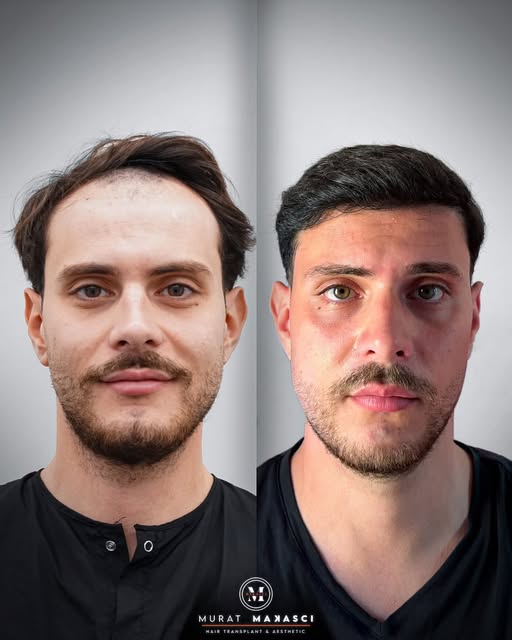 Number of grafts: 5,000 The procedure was performed on January 8, 2026. The result image shown refle